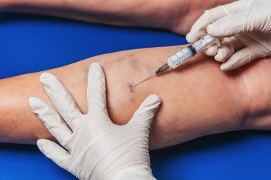 Yaşlı bir kadının bacağına yakın planda yapılan iğneler. Doktorun yaşlı bir kadının bacaklarına yaptığı iğneler. Varisli damarların tedavisi için. Varis damarları enjeksiyonları
