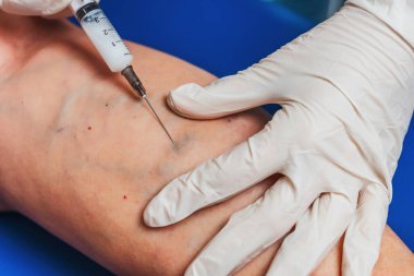 Yaşlı bir kadının bacağına yakın planda yapılan iğneler. Doktorun yaşlı bir kadının bacaklarına yaptığı iğneler. Varisli damarların tedavisi için. Varis damarları enjeksiyonları