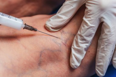 Yaşlı bir kadının bacağına yakın planda yapılan iğneler. Doktorun yaşlı bir kadının bacaklarına yaptığı iğneler. Varisli damarların tedavisi için. Varis damarları enjeksiyonları