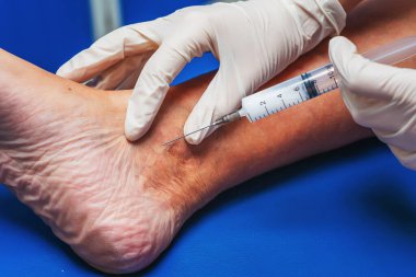 Yaşlı bir kadının bacağına yakın planda yapılan iğneler. Doktorun yaşlı bir kadının bacaklarına yaptığı iğneler. Varisli damarların tedavisi için. Varis damarları enjeksiyonları