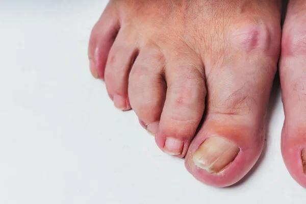 Nail fungus on the toes of an elderly woman\'s feet close-up on a white background.  The old woman\'s unkempt toenails. Calluses and sores on the feet