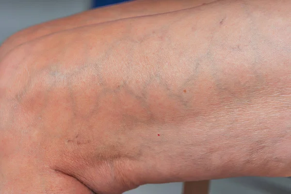 Yaşlı Bir Kadında Varisli Damarlar Bacaklarda Şişmiş Damarlar Var Lerlemiş — Stok fotoğraf