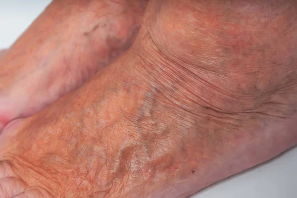 Varicose veins on the feet of an elderly woman. Inflamed dilated veins in the legs. Varicose veins in the late advanced stage. Old woman\'s feet