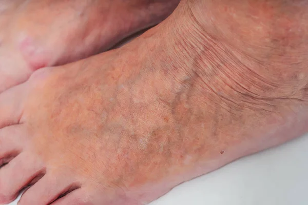 Varicose veins on the feet of an elderly woman. Inflamed dilated veins in the legs. Varicose veins in the late advanced stage. Old woman\'s feet