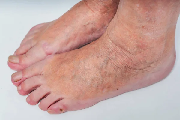 Venas Varicosas Los Pies Una Anciana Venas Dilatadas Inflamadas Las — Foto de Stock