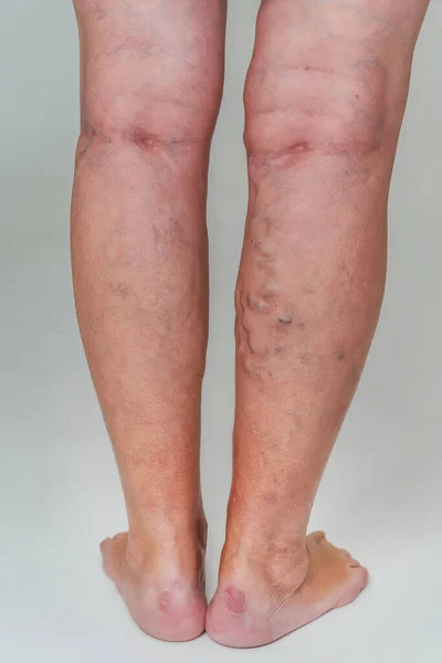 Krampfadern Bei Einer Älteren Frau Entzündete Erweiterte Venen Den Beinen — Stockfoto