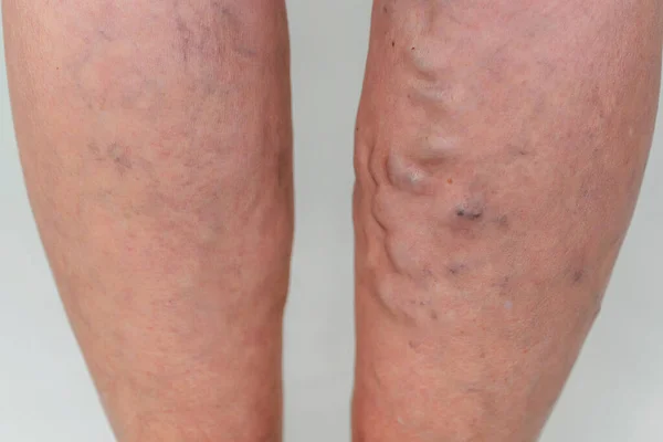 Krampfadern Bei Einer Älteren Frau Entzündete Erweiterte Venen Den Beinen — Stockfoto