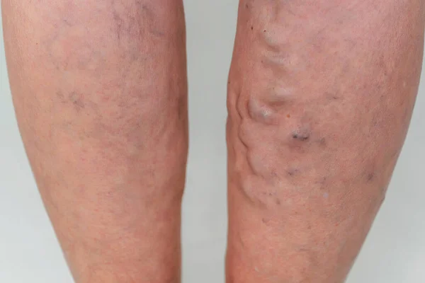 Varicose veins in an elderly woman. Inflamed dilated veins in the legs. Varicose veins in the late advanced stage.