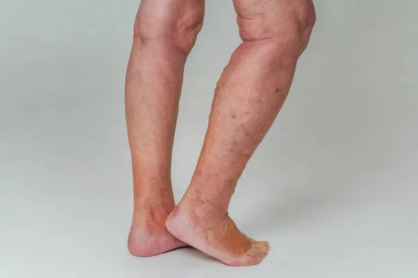 老年妇女的静脉曲张 腿上发炎的扩张静脉 晚期静脉曲张 — 图库照片