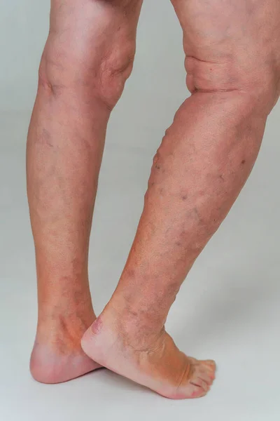 Varicose Veins Elderly Woman Inflamed Dilated Veins Legs Varicose Veins — Stock Photo, Image