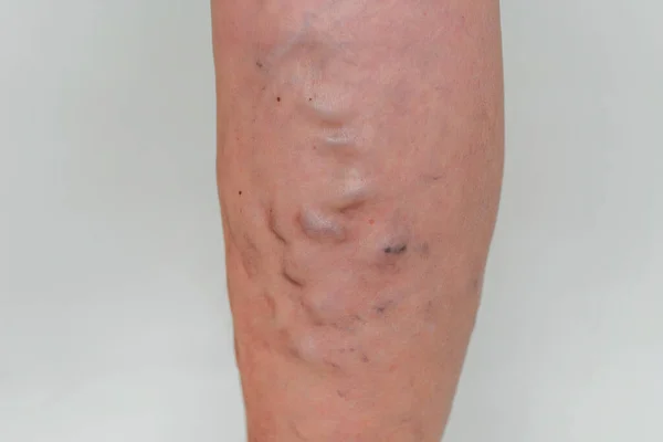 高齢女性の静脈 足の炎症を起こした拡張静脈 後期進行期の静脈瘤 — ストック写真