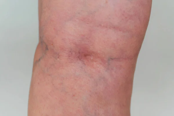 Yaşlı Bir Kadında Varisli Damarlar Bacaklarda Şişmiş Damarlar Var Lerlemiş — Stok fotoğraf