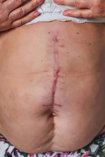 Post-operative scar on an elderly woman\'s torso body. Scar after removal of the gallbladder. The seams on the abdomen after surgery