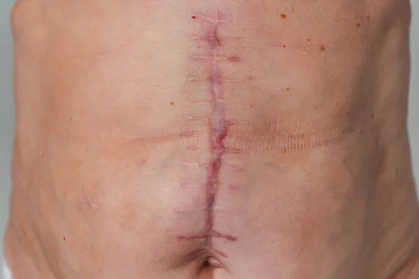 Post Operative Scar Elderly Woman Torso Body Scar Removal Gallbladder — Stock Photo, Image