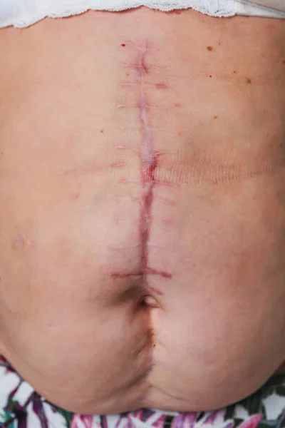 Post-operative scar on an elderly woman\'s torso body. Scar after removal of the gallbladder. The seams on the abdomen after surgery