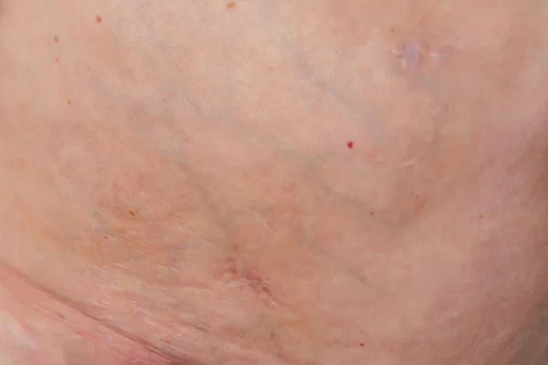Post Operative Scar Elderly Woman Torso Body Scar Removal Gallbladder — Stock Photo, Image