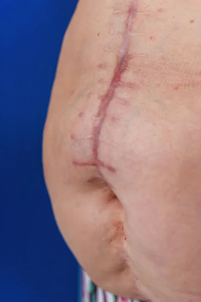 Post-operative scar on an elderly woman's torso body. Scar after removal of the gallbladder. The seams on the abdomen after surgery