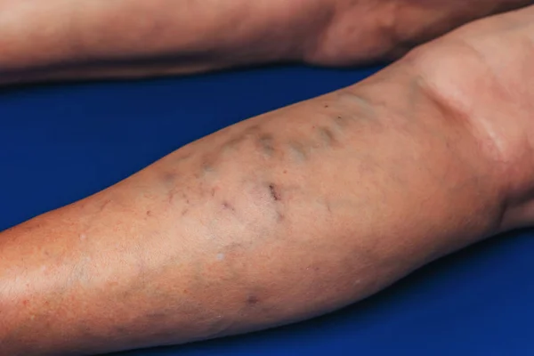 Varicose Veins Elderly Woman Inflamed Dilated Veins Legs Varicose Veins — Stock Photo, Image