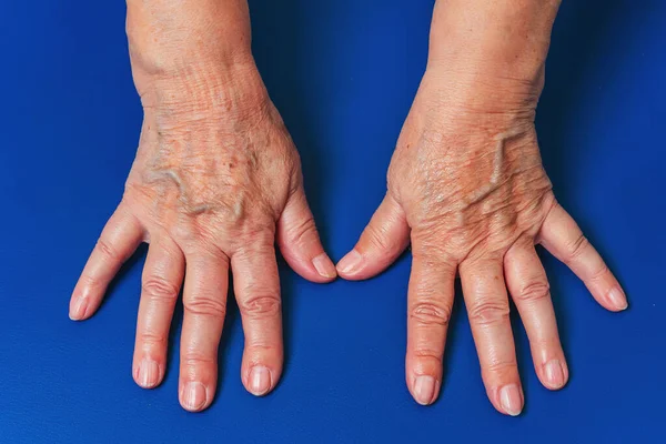 Mãos Uma Mulher Idosa Fundo Azul Close Veias Nas Mãos — Fotografia de Stock