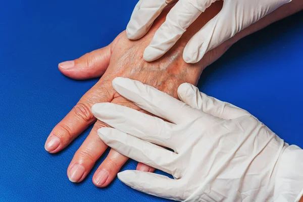 青の背景のクローズアップで高齢者の女性の手 老婦人の手に静脈の医者による検査 手の皮膚の年齢関連の変化の世話 医療用手袋の手 — ストック写真