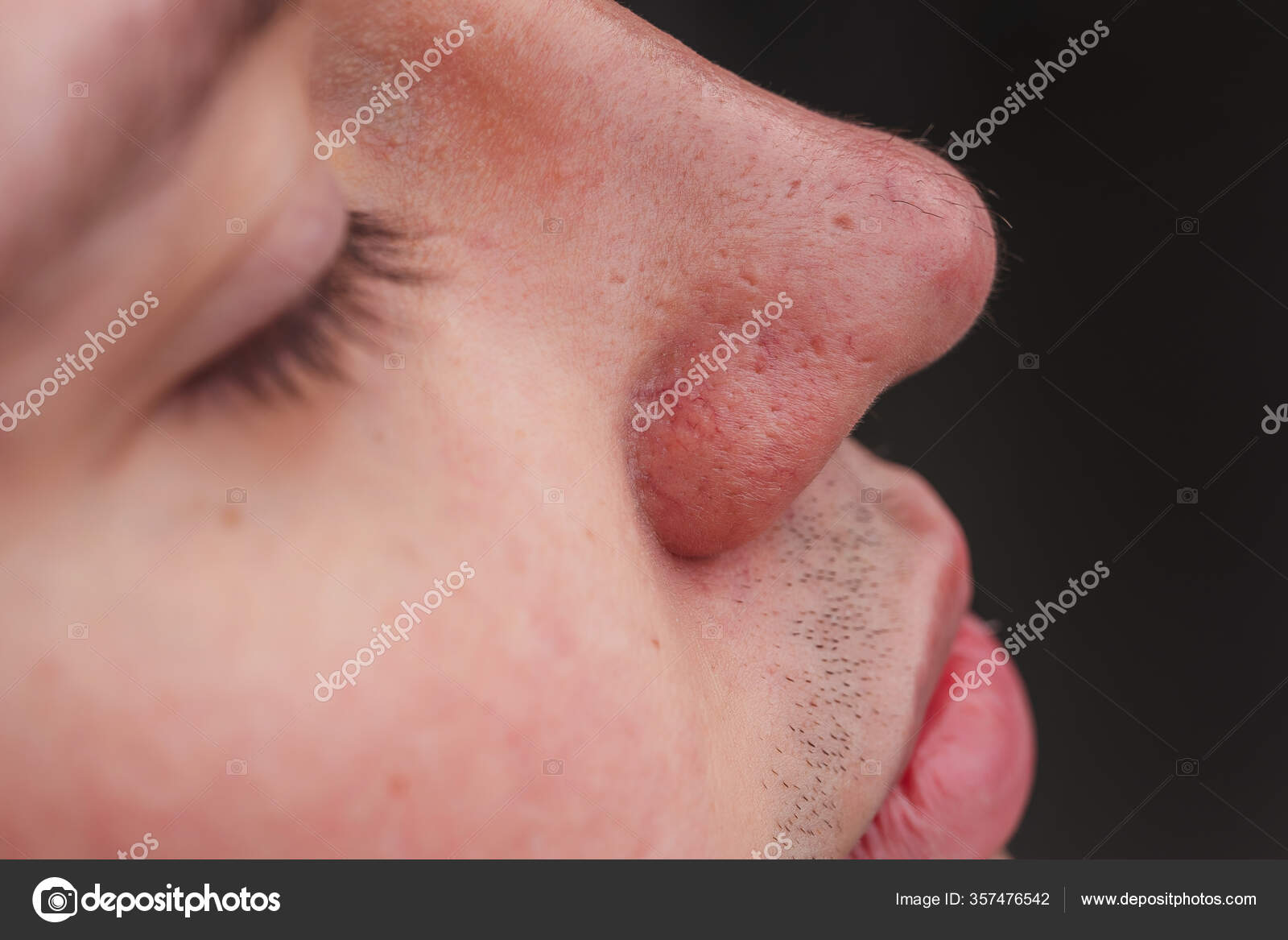 Man Nose Hair Close Hair Grows Surface Skin Nose Increased Stock Photo by  ©Kinderkz 357476542