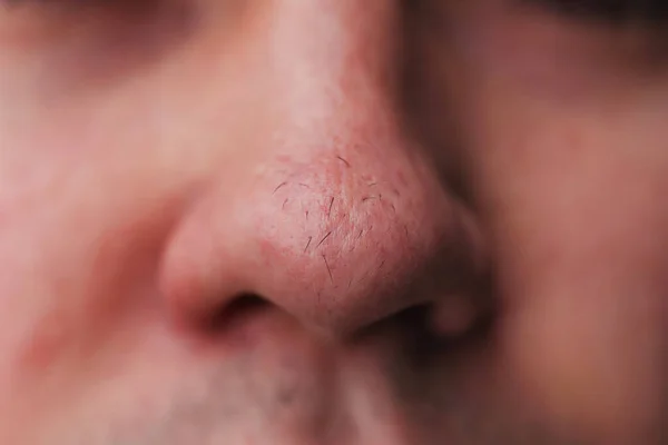 Man with nose hair close-up. Hair grows on the surface of the skin of the nose. Increased hairiness on the face. Hairy male fleshy nose close-up.