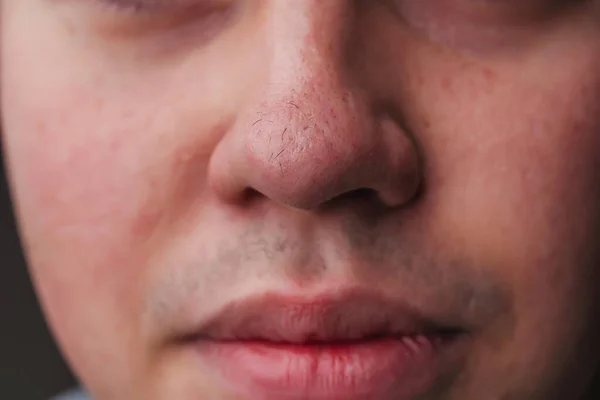Mann Mit Nasenhaaren Großaufnahme Haare Wachsen Auf Der Hautoberfläche Der — Stockfoto