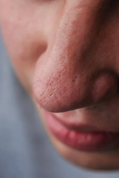 Man with nose hair close-up. Hair grows on the surface of the skin of the nose. Increased hairiness on the face. Hairy male fleshy nose close-up.