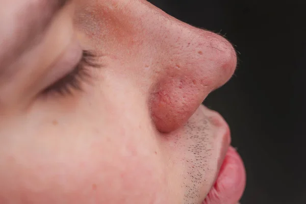 Man with nose hair close-up. Hair grows on the surface of the skin of the nose. Increased hairiness on the face. Hairy male fleshy nose close-up.