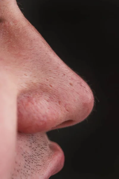 Man Nose Hair Close Hair Grows Surface Skin Nose Increased — Stock Photo, Image