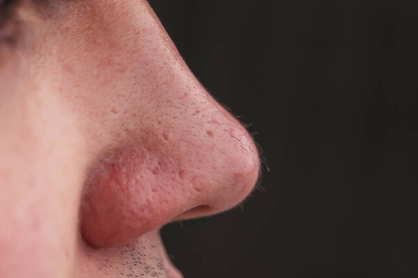 Человек с волосами в носу крупным планом. Волосы растут на поверхности кожи носа. Увеличение волос на лице. Волосатый мужской нос крупным планом
.