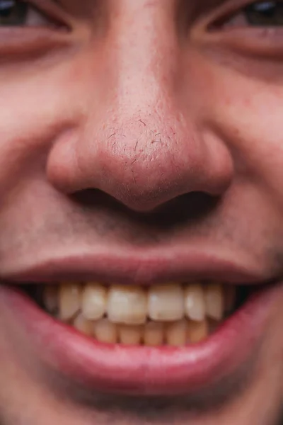 Man with nose hair close-up. Hair grows on the surface of the skin of the nose. Increased hairiness on the face. Hairy male fleshy nose close-up.