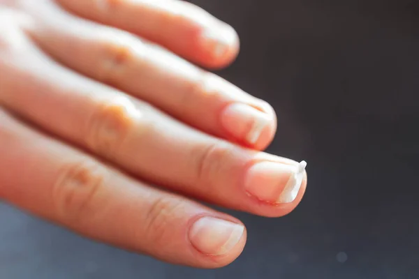 Gebrochener Fingernagel Verdorbene Maniküre Der Hand Brüchige Nägel — Stockfoto