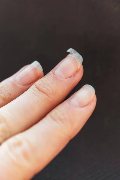 Gebroken Vingernagel Verwende Manicure Hand Broze Nagels — Stockfoto