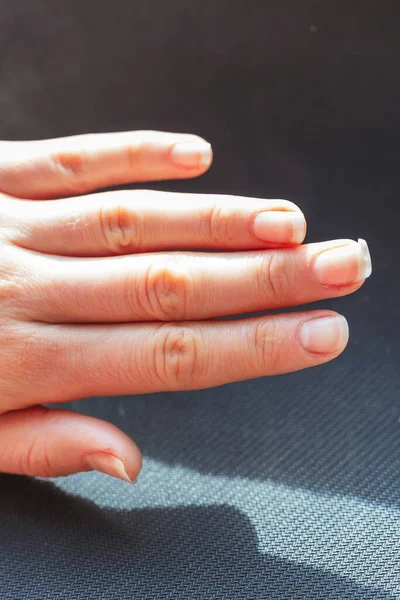 Gebroken Vingernagel Verwende Manicure Hand Broze Nagels — Stockfoto