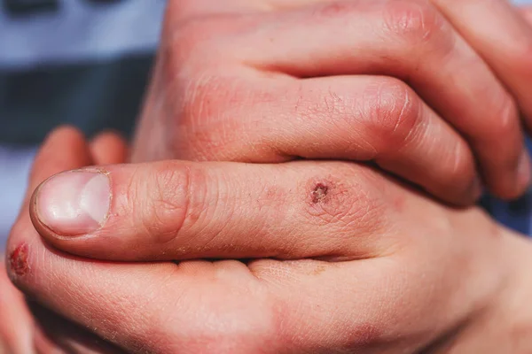 남자의 손가락을 건드린 노동자의 클로즈업하는 감각을 무디게 — 스톡 사진