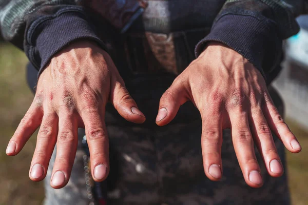 Dedos Entalados Homem Mãos Masculinas Trabalhador Close Feridas Calos Feridas — Fotografia de Stock