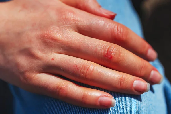 손가락에 상처가 여성은 상처로 있습니다 손가락에 — 스톡 사진