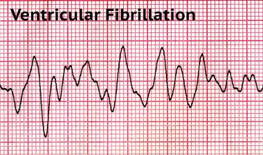 Ventriküler fibrilasyon - ölümcül kalp ritmi