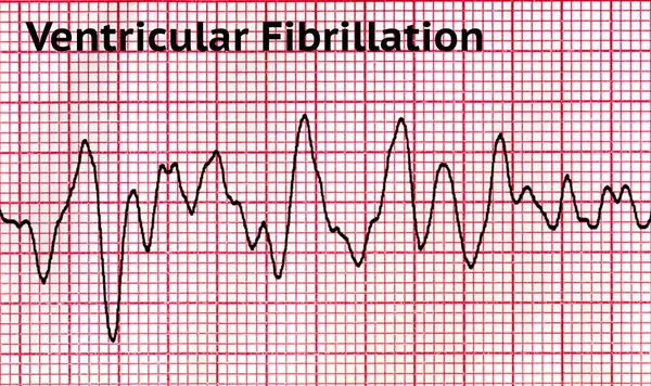 Fibrilación ventricular - Ritmo cardíaco mortal —  Fotos de Stock