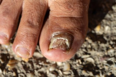 Candida Albicaları