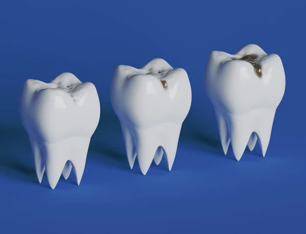 Diş çürüğünün üç aşaması var, Caries. 3d illüstrasyon