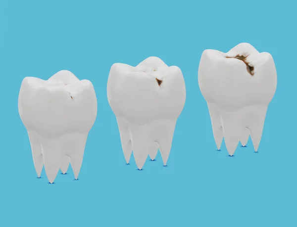 Diş çürüğünün üç aşaması var, Caries. 3d illüstrasyon