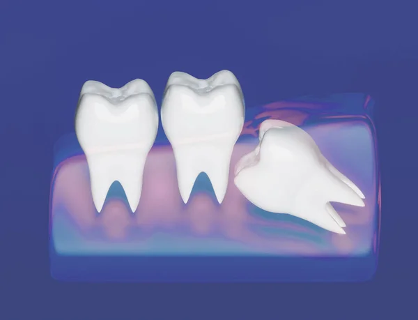 Wisdom tooth grows wrong, wisdom tooth problem, horizontal position of the wisdom tooth, Impacted wisdom tooth. 3d illustration
