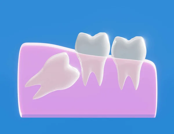 Ząb Mądrości Rośnie Źle Problem Zębami Mądrości Pozioma Pozycja Zęba — Zdjęcie stockowe