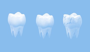 Kırık azı dişi ve tüm diş, mavi arka planda izole edilmiş. 3d illüstrasyon