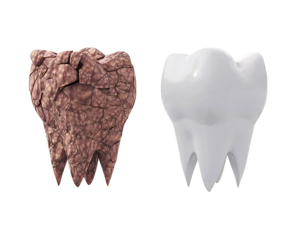 Schmutzbelag Gebrochener Backenzahn Und Sauberer Weißer Zahn Isoliert Auf Weißem — Stockfoto
