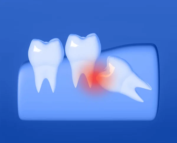 Wisdom tooth grows wrong, wisdom tooth problem, horizontal position of the wisdom tooth, Impacted wisdom tooth. 3d illustration