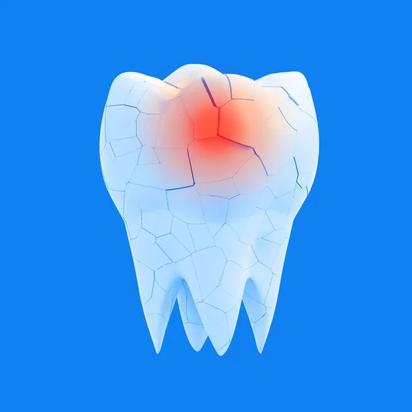 Diente Molar Roto Con Punto Rojo Sobre Fondo Azul Concepto — Foto de Stock