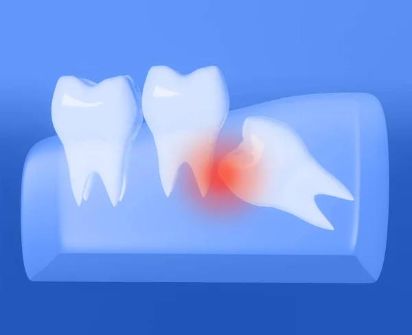 Yirmilik diş yanlış çıkar, yirmilik diş sorunu, yirmilik dişin yatay konumu, yirmilik dişe çarpma. 3d illüstrasyon